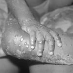 Mpox Outbreak Declared A Public Health Emergency Of International Concern